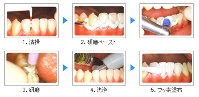 歯のクリーニング（PMTC）でもホワイトニングできる？